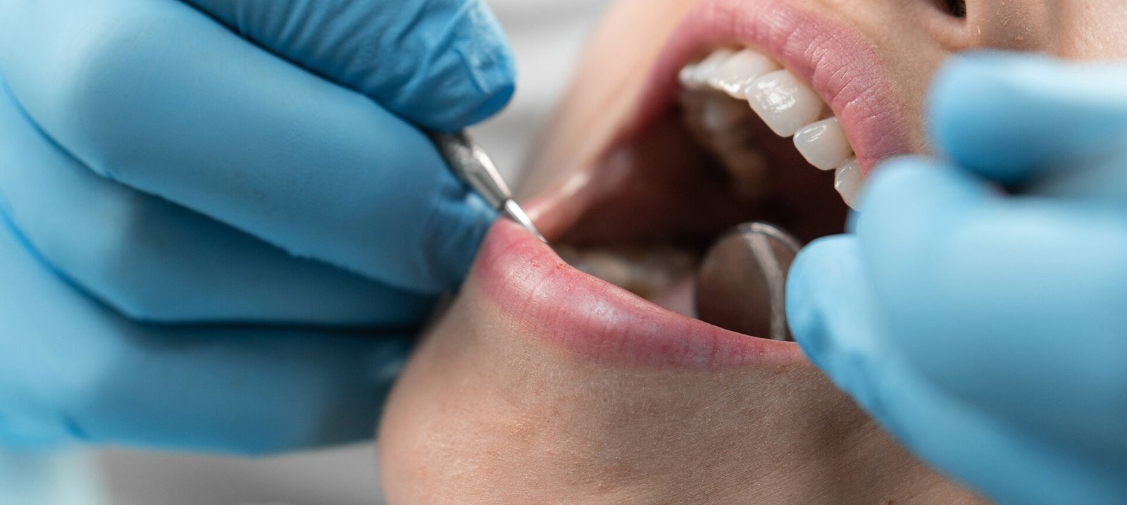 preventive dental care offered at Renton dental office Go Dentistry