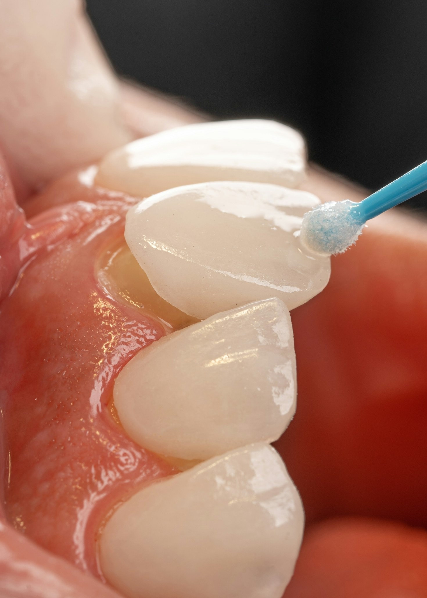Understanding the All-on-4 Procedure: A Patient’s Guide